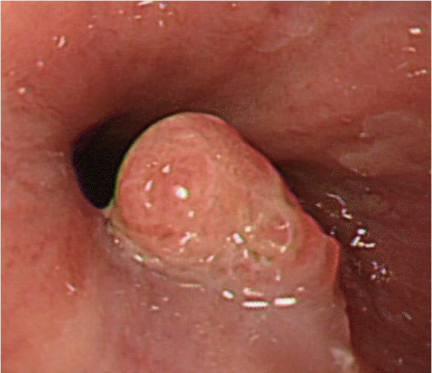 squamous papilloma ge junction