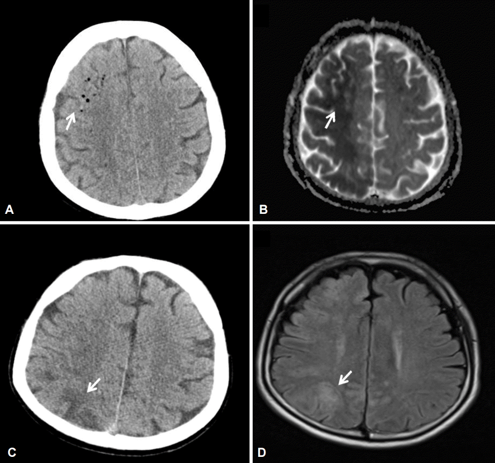 Two Cases of Cerebral Air Embolism That Occurred during Esophageal ...