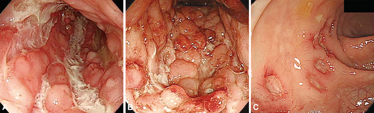 Colitis ulcerosa cronica